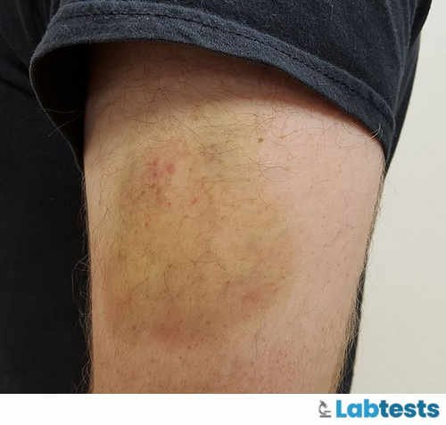 What Complications Can You Face During Blood Collection & How to perform Venipuncture ? 3 Hematoma Formation on the arm