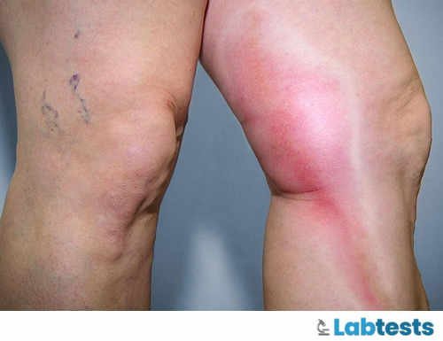 What Complications Can You Face During Blood Collection & How to perform Venipuncture ? 4 Phlebitis on the Leg image