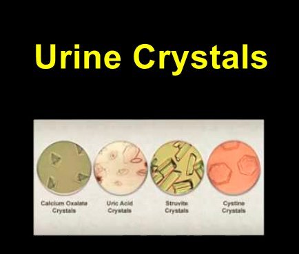 urine renal crystals