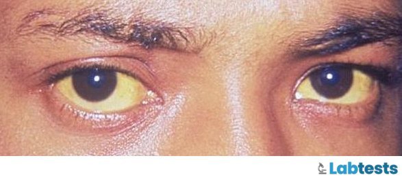 Clinical jaundice appearing in patient’s eyes.