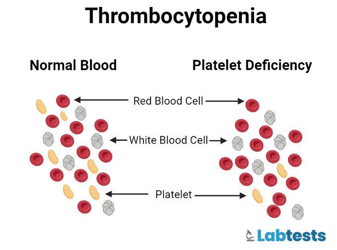 Thrombocytopenia