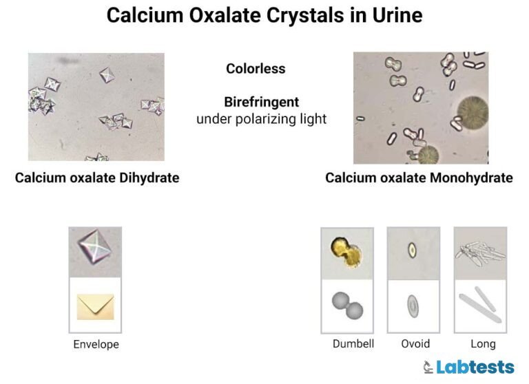 calcium oxalate monohydrate and dihydrate crystals in urine